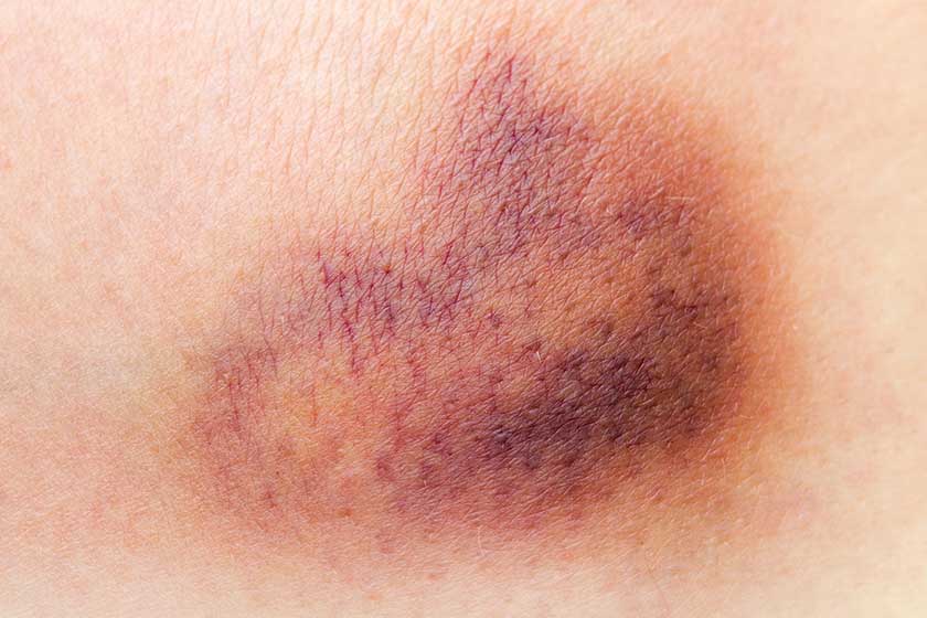 Loving Care: How To Support Your Elderly Loved One With Skin Bruising